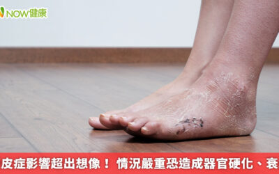 硬皮症影響超出想像！ 情況嚴重恐造成器官硬化、衰竭